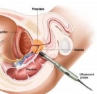 Prostate Gland Ultrasound and Biopsy Humor